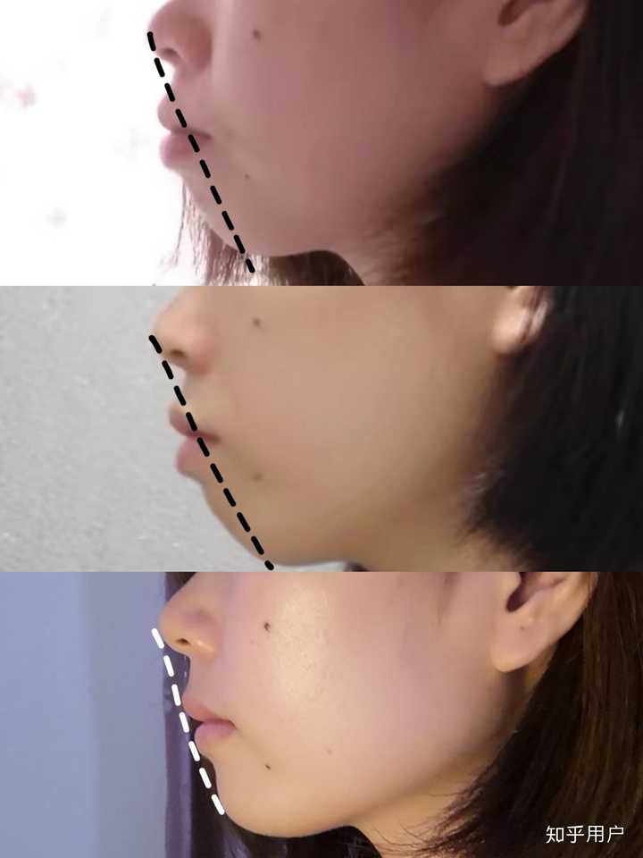 牙齿矫正对个人外貌变化有多大影响?