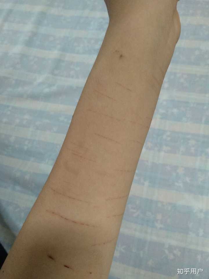 如何向朋友解释自残后的伤疤?