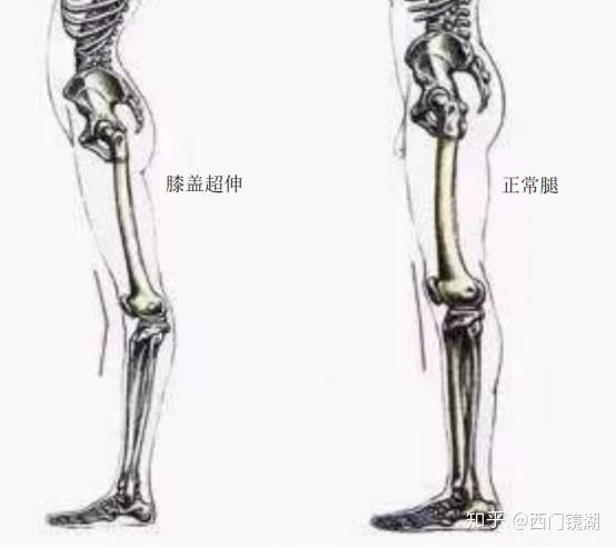 你是比较罕见的o型腿, 大腿股骨内旋【下图红线】.