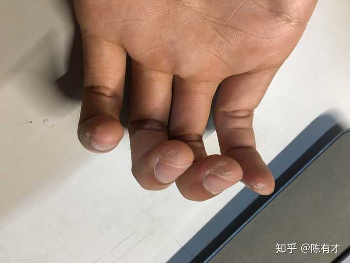 玩吉他的朋友可以拍一张左手手指上的茧吗?