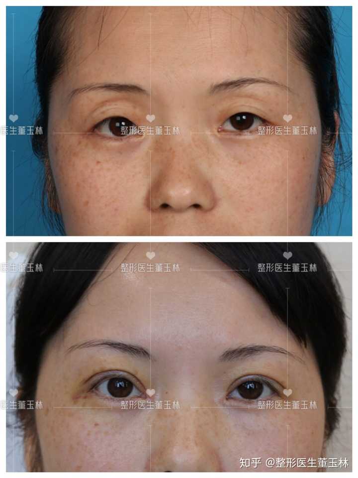 有没有朋友在成都做个双眼皮,做得怎么样?在哪做的?