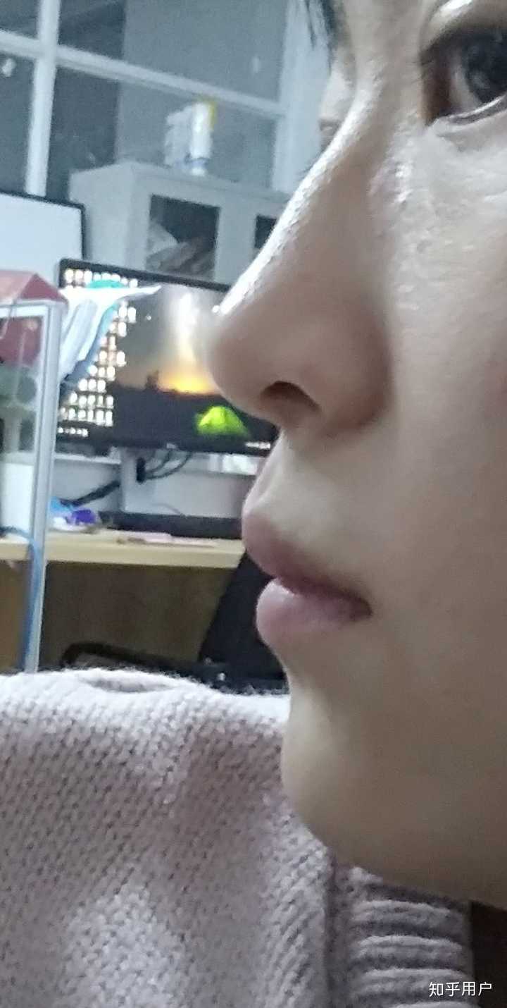 24岁 嘴凸 侧脸线条简直丑哭,怎么办 正畸有用吗?