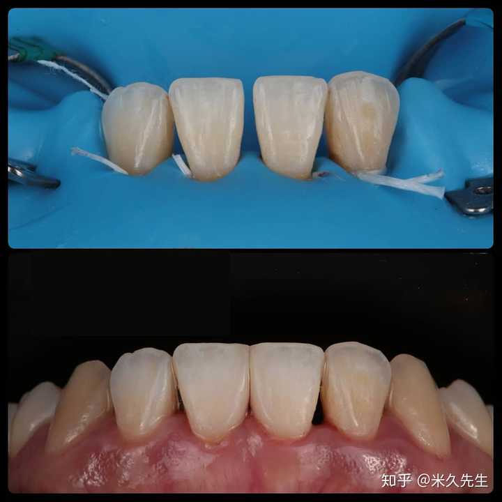 不同于一般修复,如果修补材料直接填满牙缝,存在着刺激牙龈的威胁,这