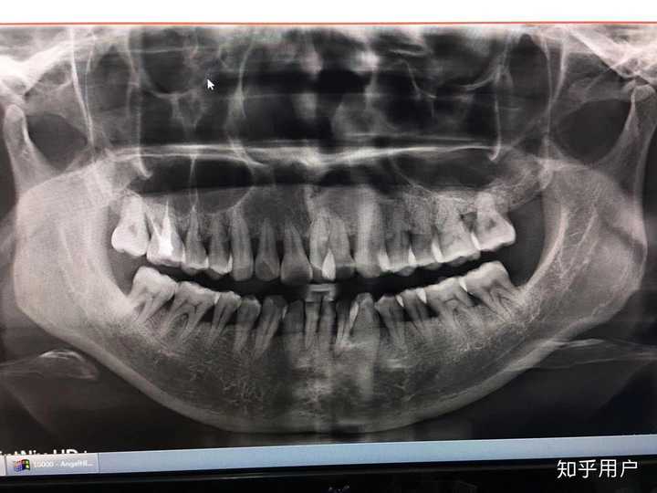 25 岁后去矫正牙齿(戴牙套)是什么体验?