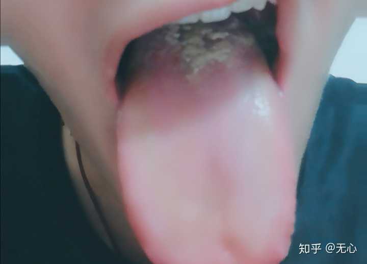 怎么排人体湿气?