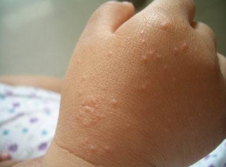 四岁女宝从未起过湿疹,近日双手沙土皮炎,浑身湿疹,求