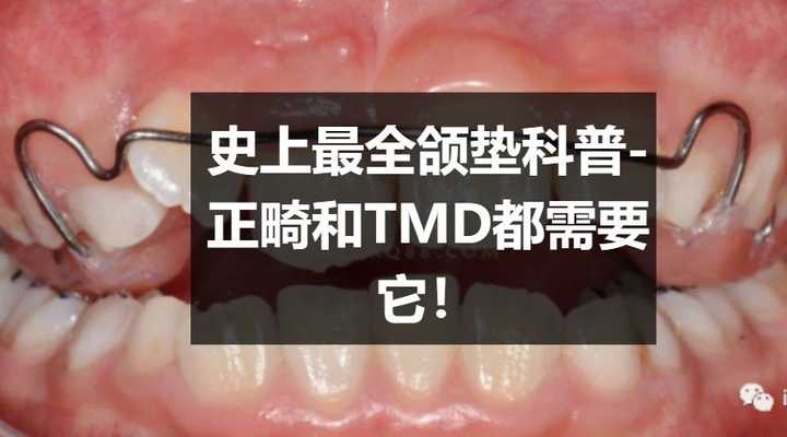 iceyuki 的想法 i牙科普君:史上最全颌垫科普-正畸和tmd都需要它!