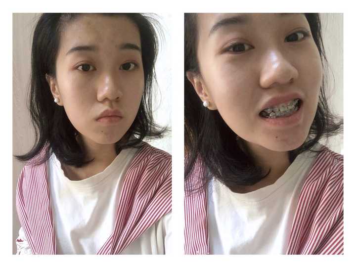 戴过牙套(矫正牙齿)的人脸型变了吗?