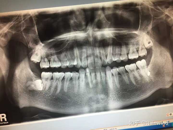 首先,在我们医院拔牙无论什么情况下都需要拍片子的,一张清晰,准确的