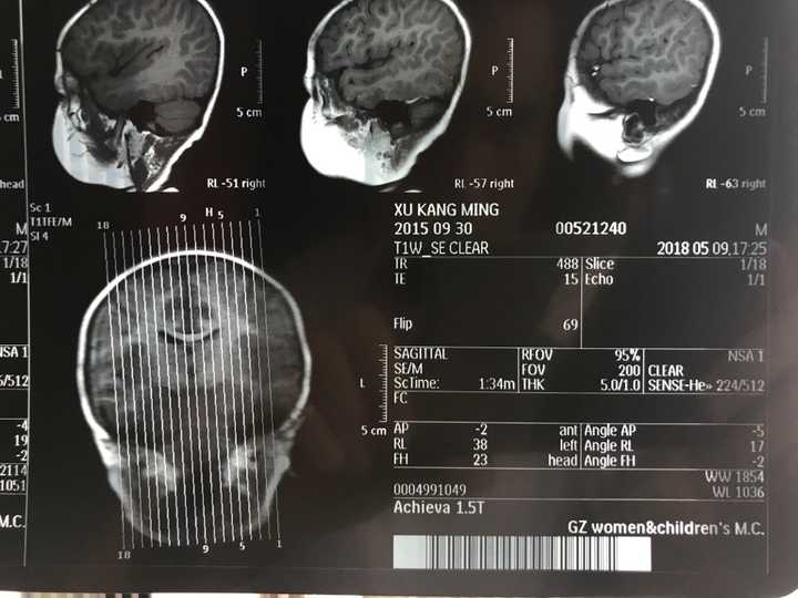 磁共振,双侧半卵圆中心及侧脑室后角旁白质异常信号,考虑扩大的血管