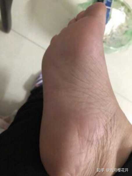 脚上脱皮,之前痒起小痘痘,破了流水?