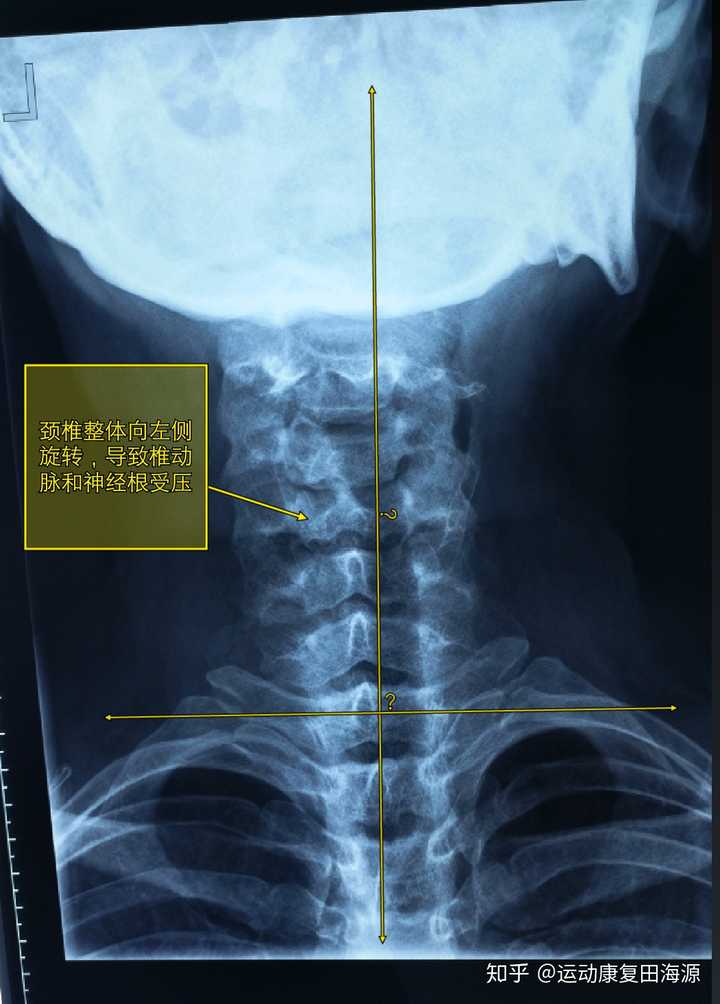 脊椎有轻微侧弯颈椎部分偏右右侧肩胛骨低背部凸起提肩可消失斜方肌不