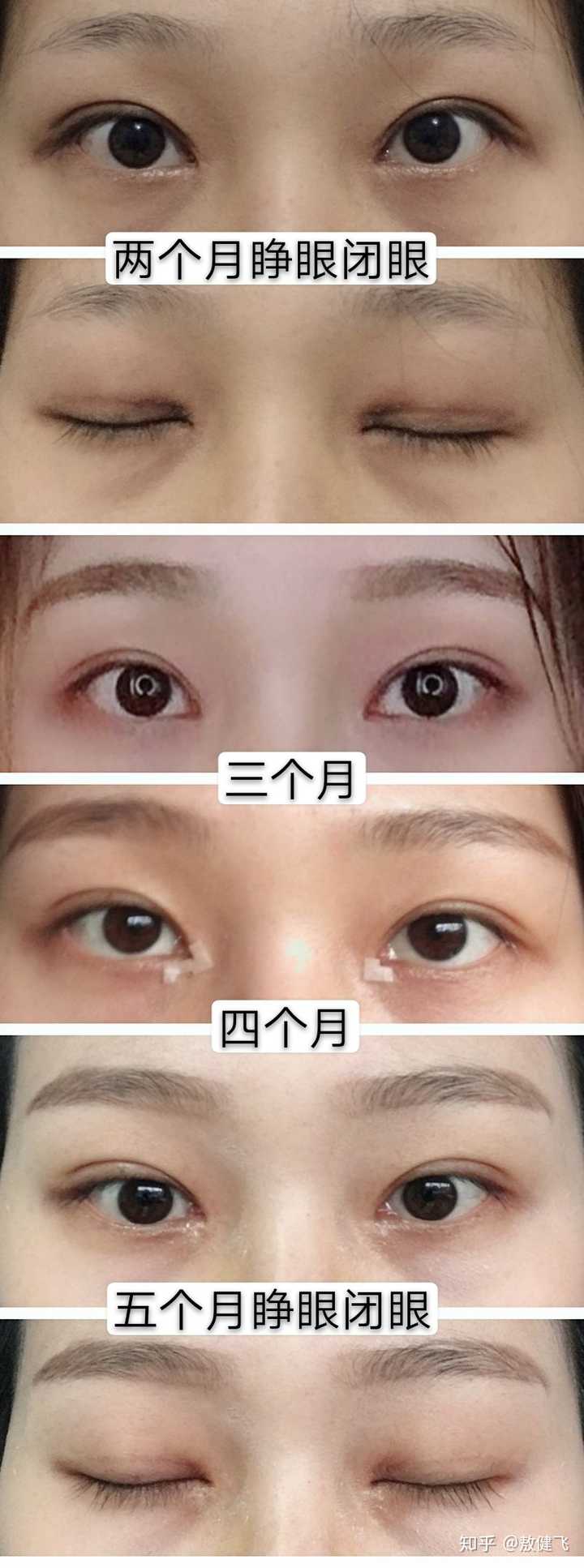 请问我的眼睛能做埋线吗?还是必须切呢?还能做美瞳线吗?