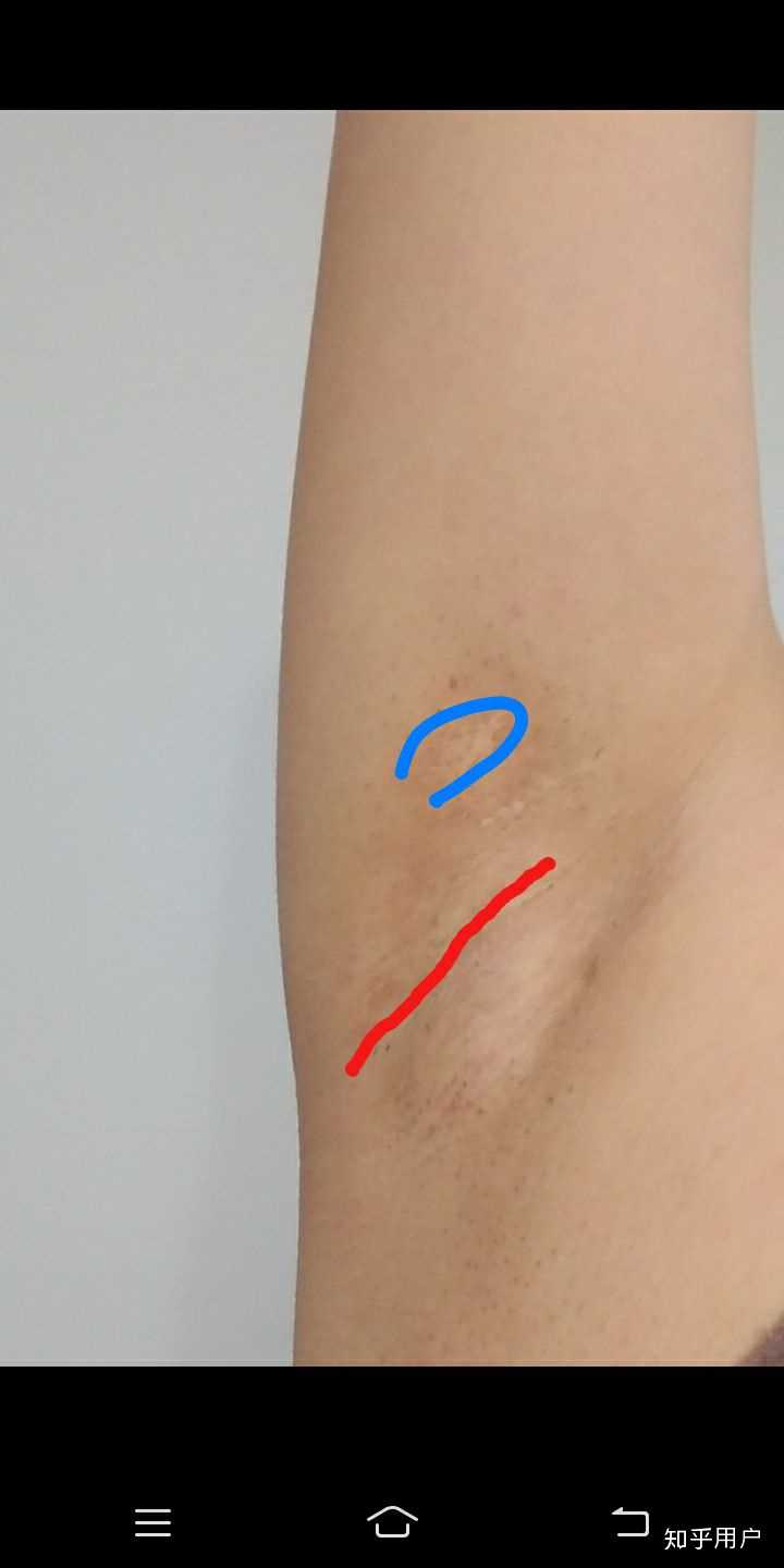做腋下大汗腺切除手术是什么体验?