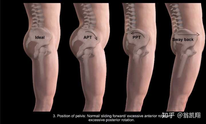 骨盆位置:正常/骨盆前倾/骨盆后倾/过度向后旋转