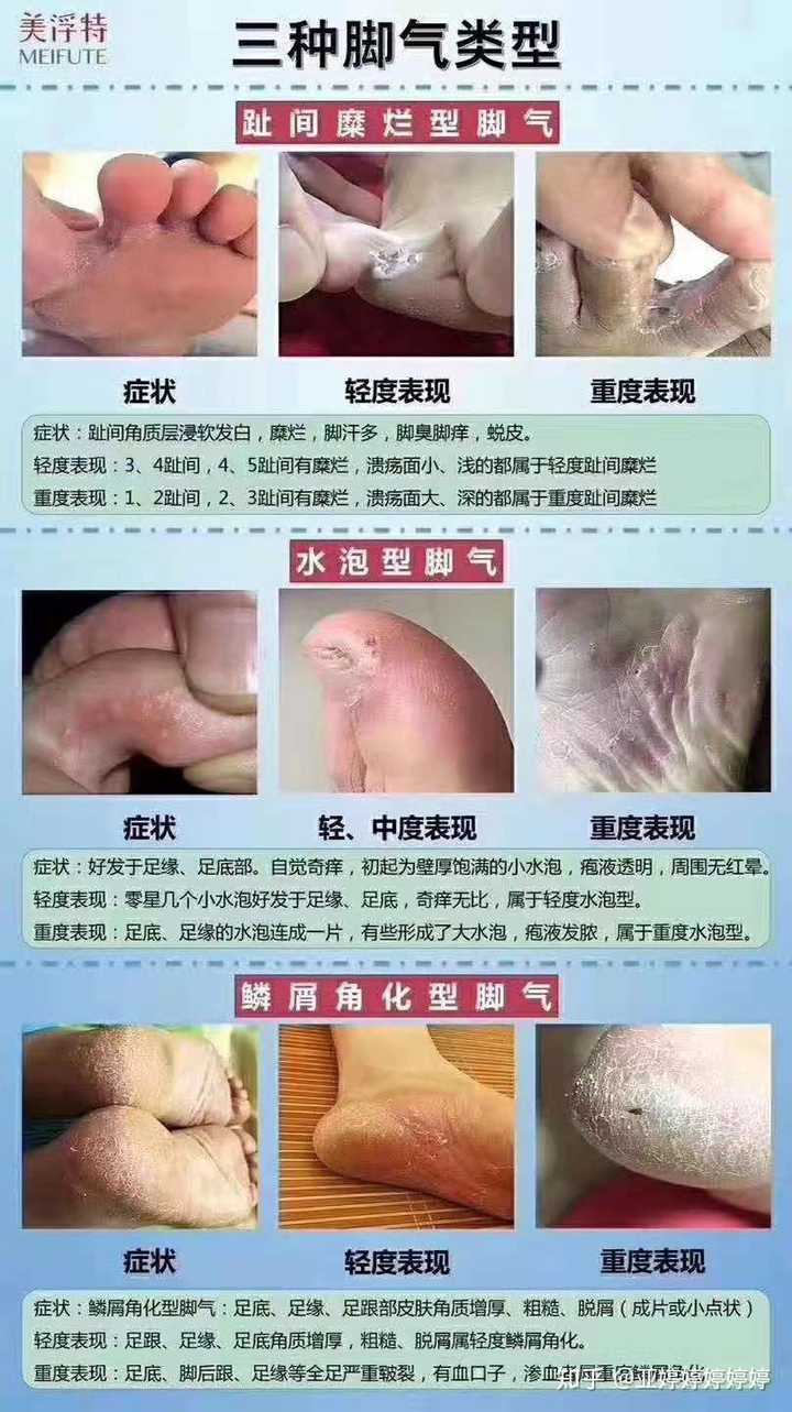 3,鳞屑角化型脚气:脚不疼不痒,脚后跟厚,粗糙,爆皮,开裂.有裂口渗血.