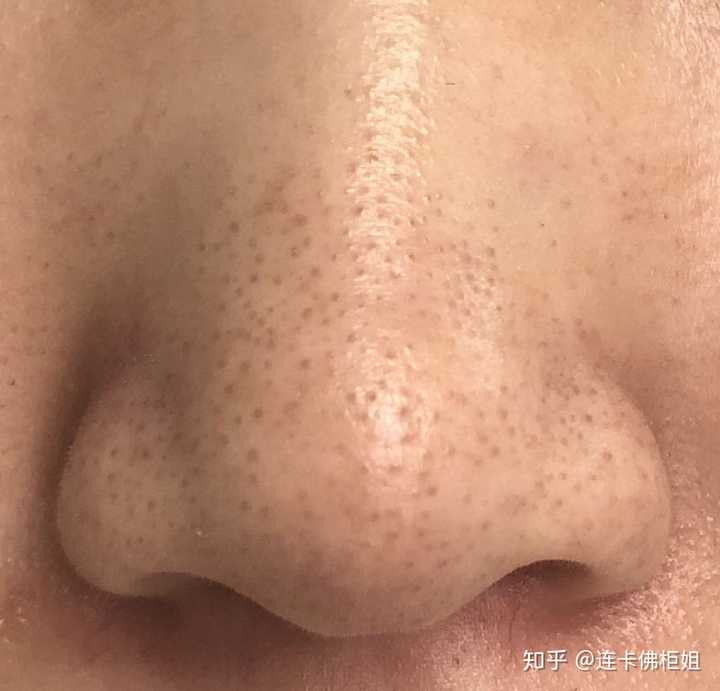 黑头和白头本质上没有区别,都是油脂颗粒.(注意