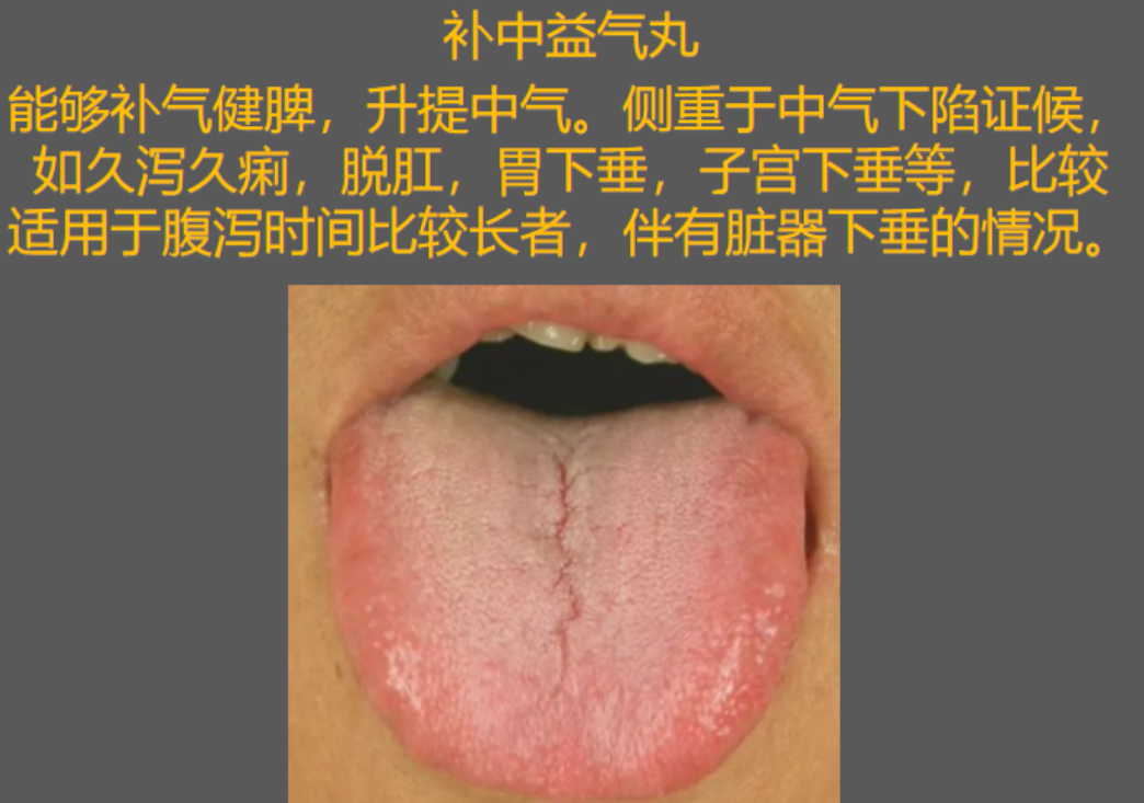 脾虚湿气重有齿痕舌怎么办