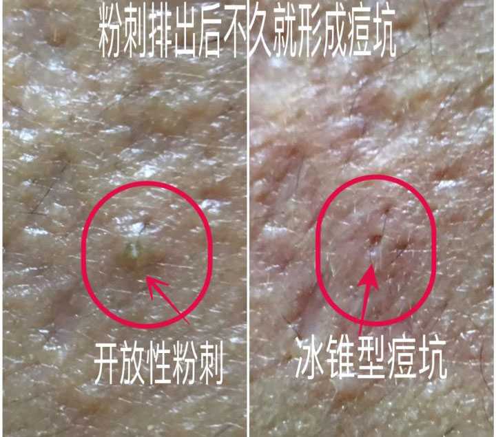 但是鱼石脂软膏那个味实在接受不了,而且很油腻,只能晚上睡觉涂,容易