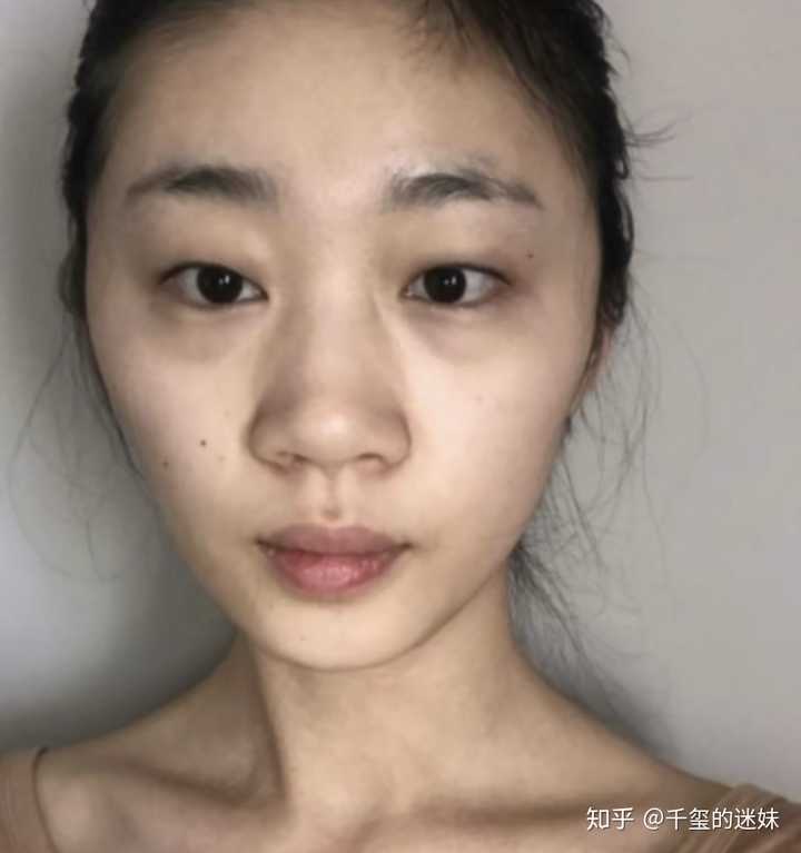首先谢邀 先给你们看一下我之前的塌鼻子吧,真得是特别丑 我从小就