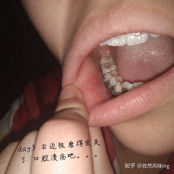 25 已经磨白了,还是有点痛的 可能过几天就能重温 口腔溃疡的痛感了