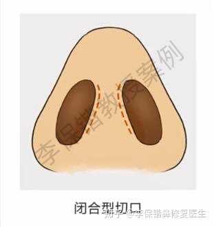 隆鼻切口问题?