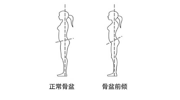 首先什么是骨盆前倾?