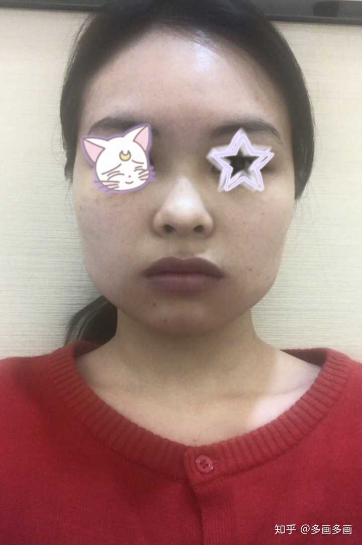 咬肌只能通过打瘦脸针才能瘦吗?