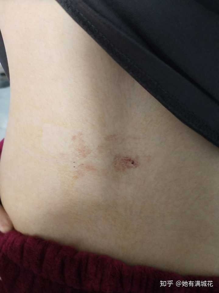女生经历痔疮手术是怎样一种体验?
