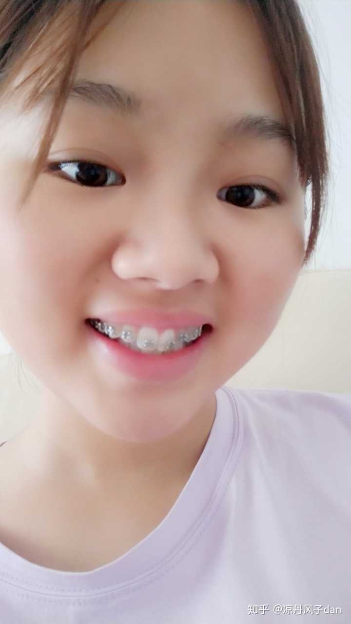 女生矫正牙齿是怎样一种体验?