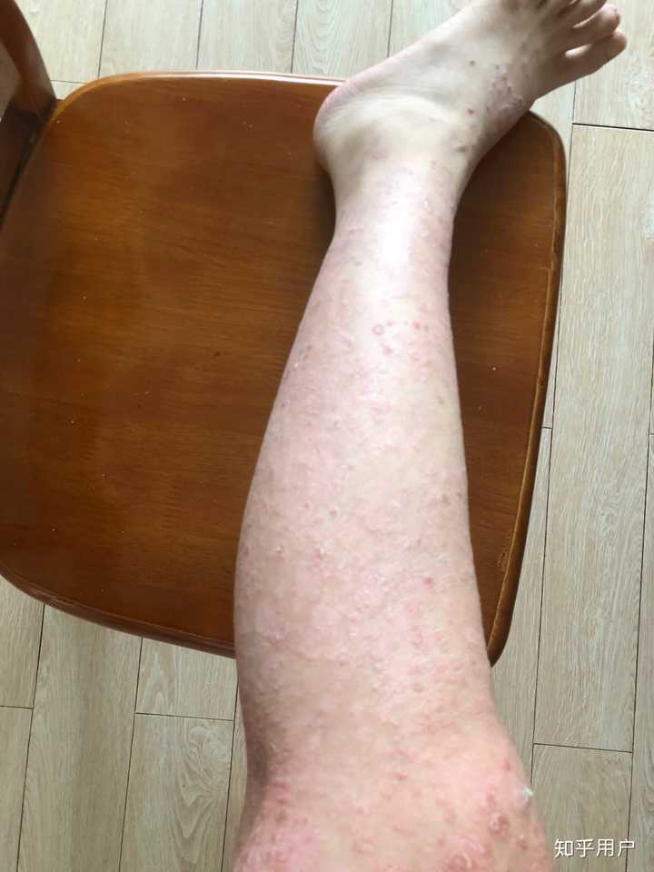 是7月27号 我一个27岁的小姑娘,得这个病已经十多年了去年到北京工作