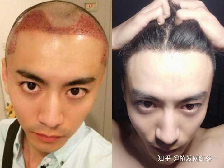 来直观展,从逆天级的植发,到明星级的秀发.