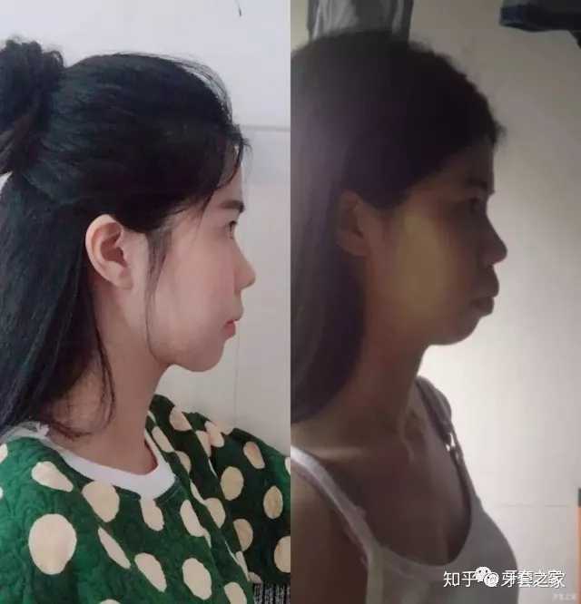 没下巴是怎样的体验