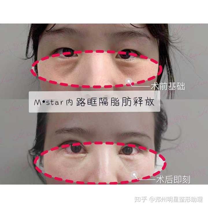 什么可以丰泪沟?