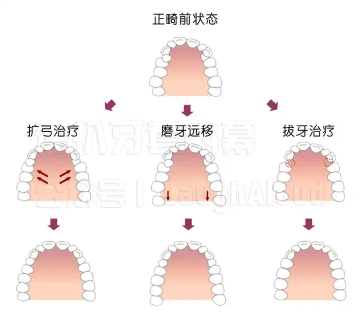 扩弓会改变脸型吗图片