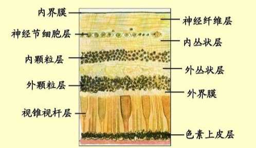 高度近视视网膜脱落的案例多吗什么样的剧烈运动不能做