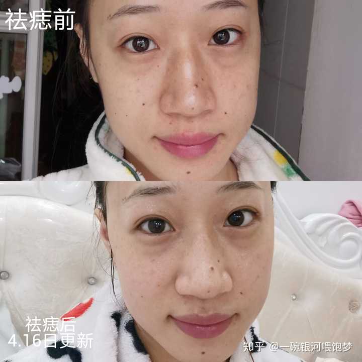 点痣选择何种方式好,有什么注意事项呢?