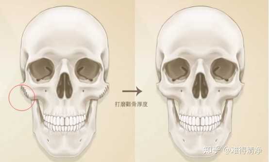 颧骨内推和磨骨到底有什么区别?