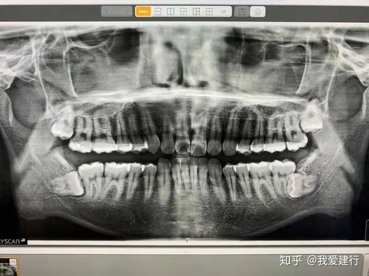 去了附近的牙科诊所拍片发现了两侧下面都有智齿,而且还是埋伏在骨头