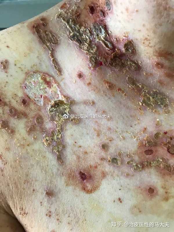 蛇串疮早记载见于隋朝巢元方《诸病源候论》 , " 甑带疮者缠腰生,状
