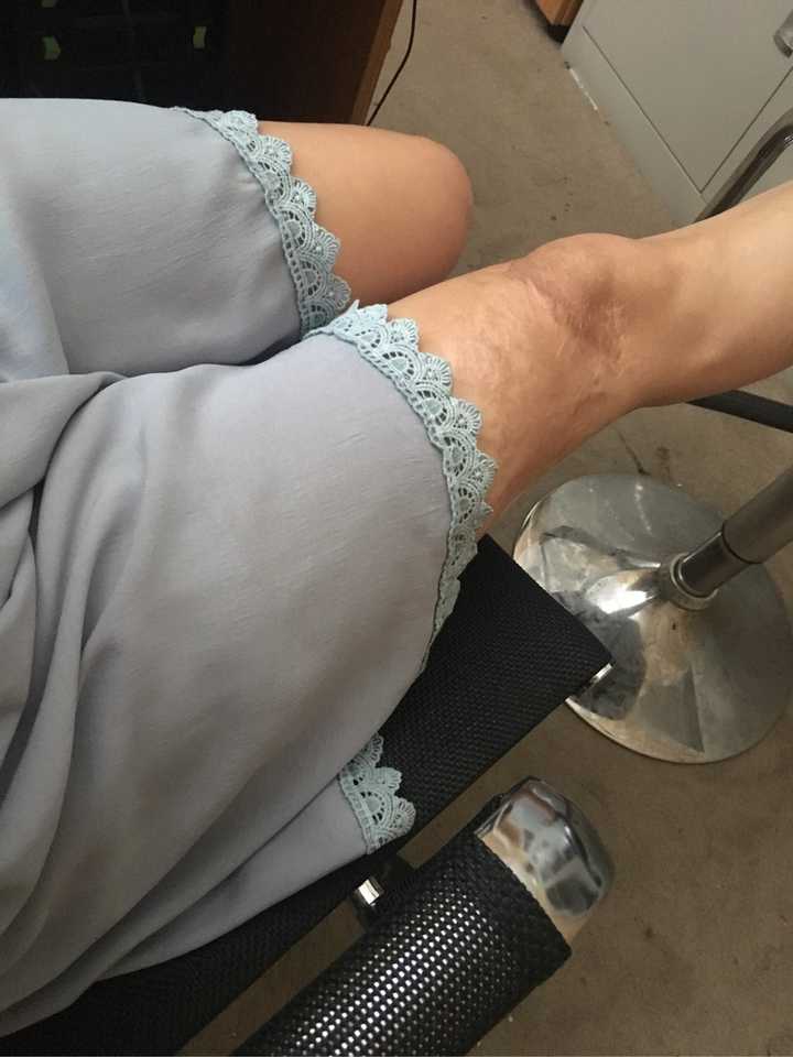 人们看到一个腿上有烫伤疤痕的女孩会怎么想呢?