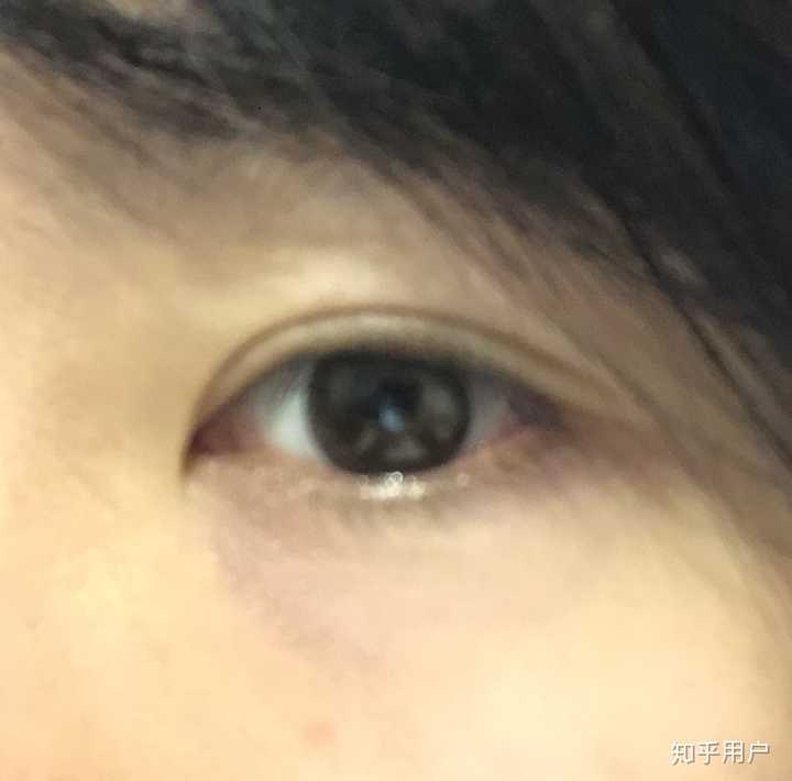 割双眼皮十年后会怎样?