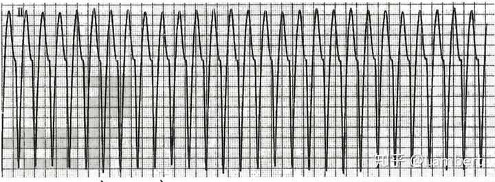 室性心动过速的心电图表现,这样的心电图应该所有人都能看明白和正常