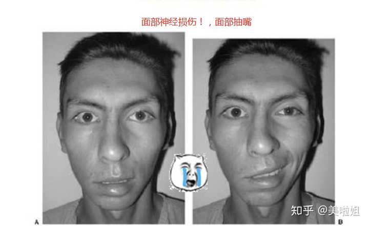 先看一下这些磨骨,削骨后遗症吧