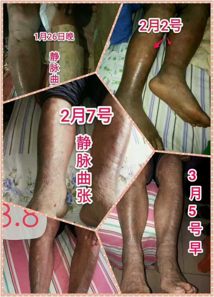 静脉曲张很严重如何有效治疗