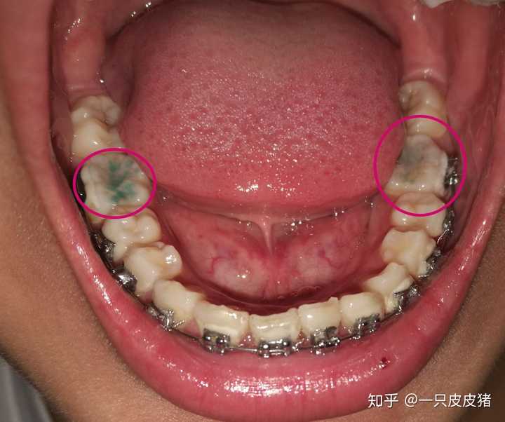 下排牙…那个就是磨了过后的样子,是磨不干净的