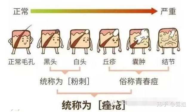 请问长痘痘的时候要少吃什么?