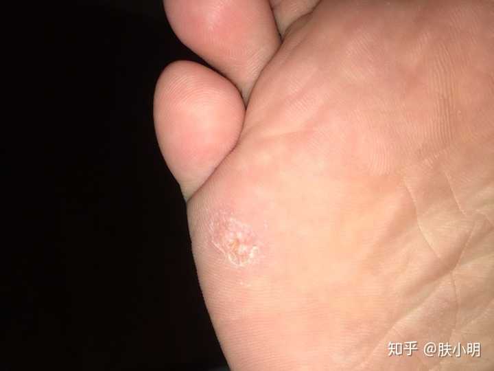 自己的跖疣传染给室友了,该怎么办?