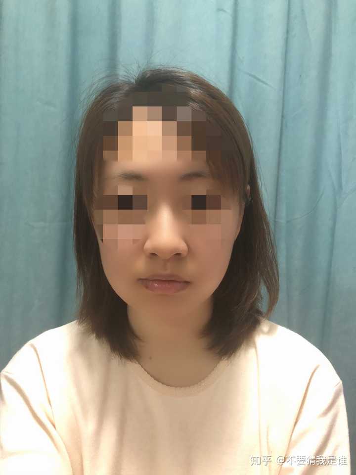 我也是大小脸,一直都是右侧睡觉,习惯右侧咀嚼,现在看起来右脸大,嘴也