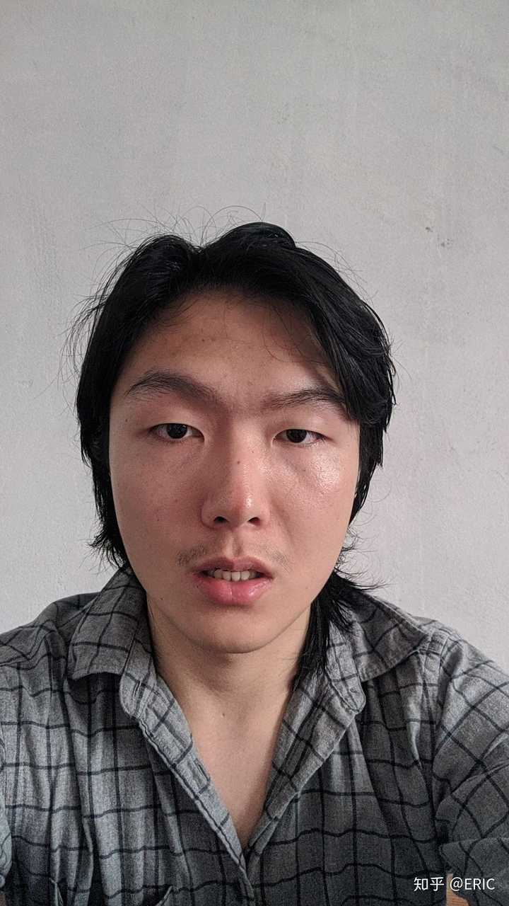 左右脸不对称怎么办?(带图)?